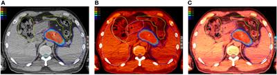 Dose evaluations of organs at risk and predictions of gastrointestinal toxicity after re-irradiation with stereotactic body radiation therapy for pancreatic cancer by deformable image registration